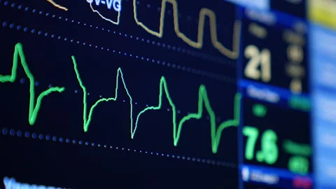 The lines moving across the screen. Close up. Vital signs monitor tracking Stock Footage 335167578