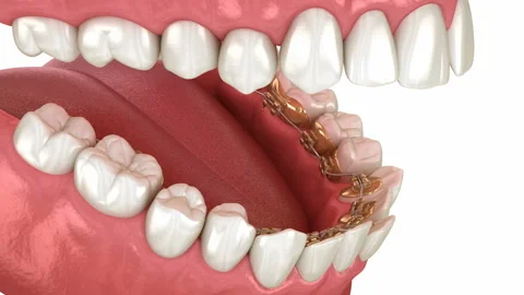 Lingual braces system, bite correction. 3D animation concept of golden braces Stock Footage 144664539