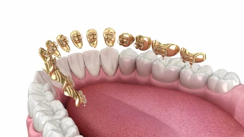 Lingual golden braces system. 3D animation concept of golden braces Stock Footage 129323722