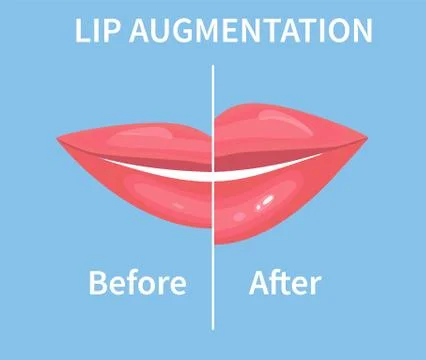 Lip Augmentation. Before and after lip filler injections. Vector illustration Ilustração Stock