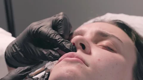 Lip Augmentation Injection Close Up Female Face Beauty Procedure Stock Footage 315863953