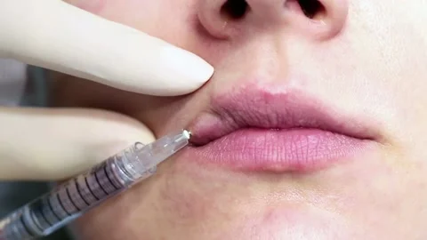 Lip augmentation injection process Vídeo Stock 153047260