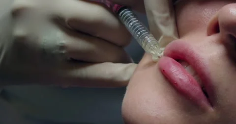 Lip augmentation injection. Professional cosmetologist injects hyaluronic acid Stock Footage 257376249