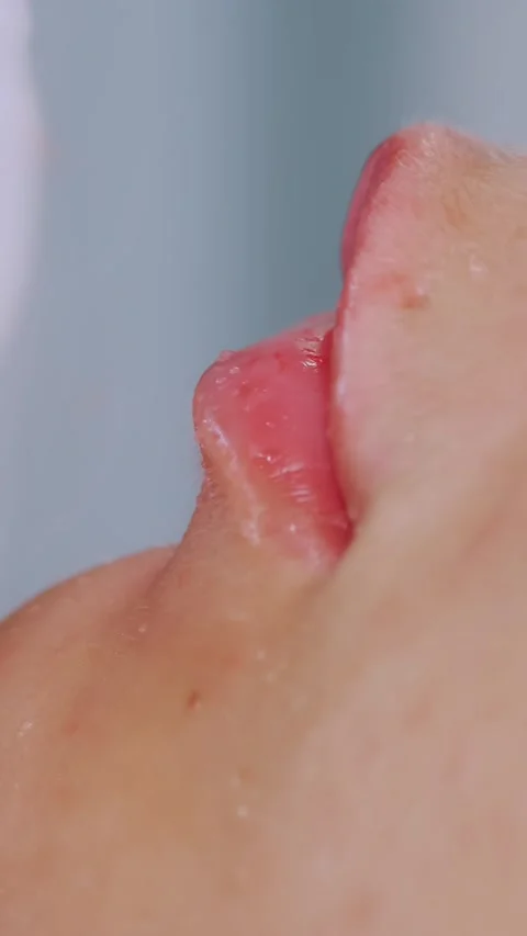 Lip augmentation procedure. close-up, female face. Surgeon, in medical gloves, Stock Footage 314887640