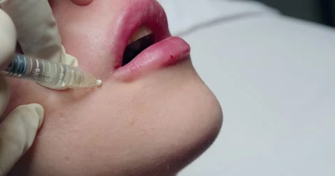 Lip augmentation procedure. Cosmetologist injects filler into woman's lips. Lip Stock Footage 260083373