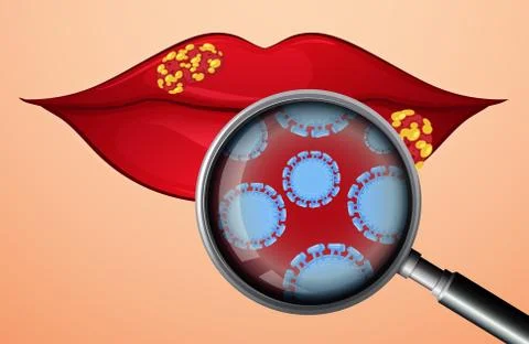 A Lip with Herpes Virus Stock Illustration