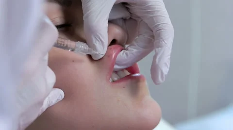 Lip injection plastic surgery. Closeup Stock Footage 58933871