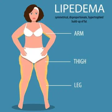 Lipedema disease concept vector design Stock Illustration