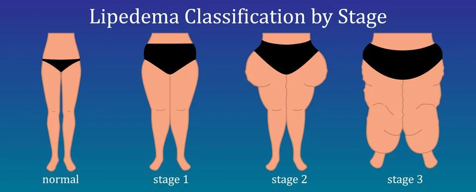 Lipedema disease concept vector design Stock Illustration
