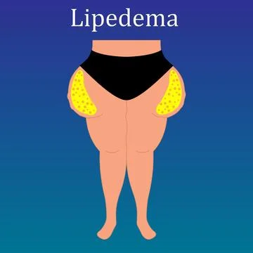 Lipedema disease concept vector design Stock Illustration