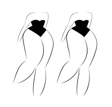 Lipedema disease concept vector design Stock Illustration
