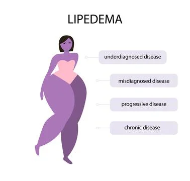 Lipedema disease concept vector design Stock Illustration