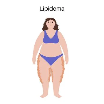 Lipedema fat zones Ilustración de archivo