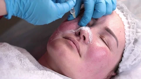 Lipolytic injections to remove subcutaneous fat. Stock Footage 201620162