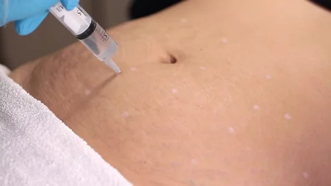 Lipolytic injections to remove subcutaneous fat. Stock Footage 201620187
