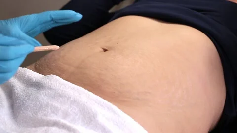 Lipolytic injections to remove subcutaneous fat. Stock Footage 201620195