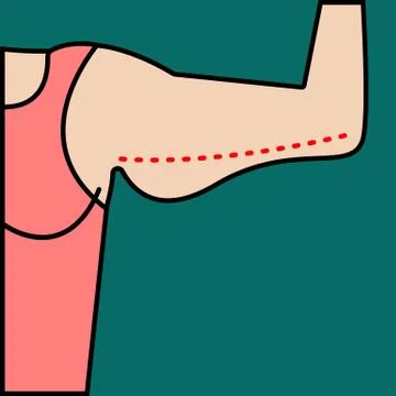 Liposuction of arms Stock Illustration