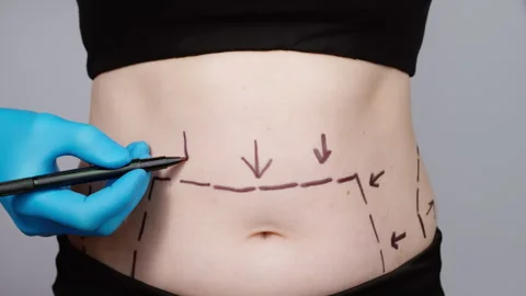 Liposuction concept. Plastic surgery to remove fat deposits on the abdomen.  Vídeo Stock 255653562