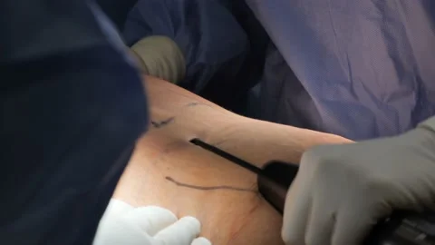 Liposuction corrective plastic surgery for liposuction of fat deposits in the Stock Footage 204869913