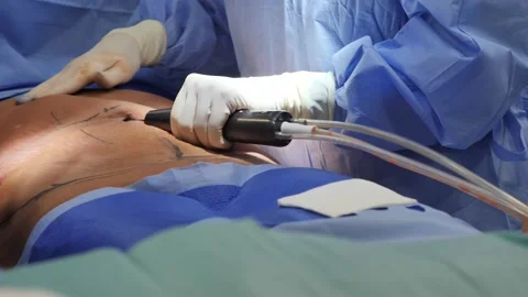 Liposuction corrective plastic surgery for liposuction of fat deposits in the Vídeo Stock 204870051