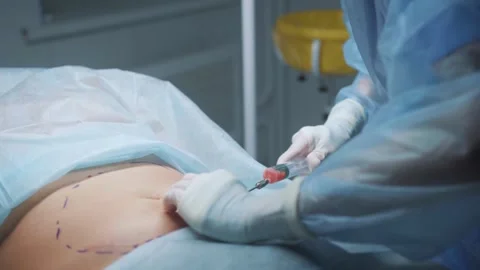 Liposuction procedure focused on abdominal area with expert care and precise Stock Footage 295863917