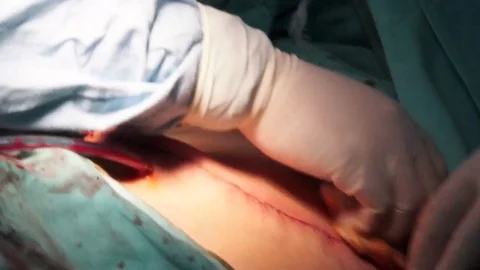 Liposuction surgery close up Stock Footage 69832680