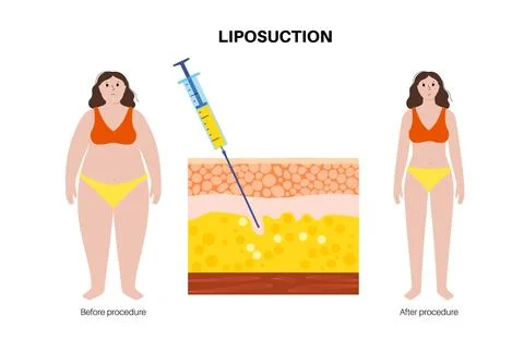 Liposuction surgery procedure Stock Illustration