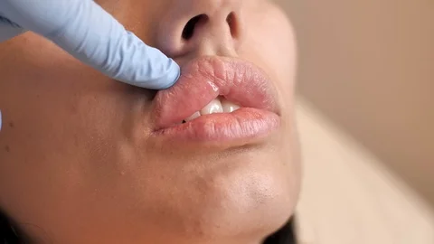 Lips after lip injection. Close up of doctor's hand in a gloves touching big Stock Footage 123286084