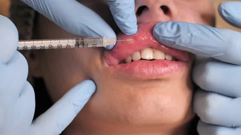 Lips augmentation procedure. Surgeon hands, in medical gloves, pierces woman's Video stock 221946284