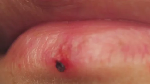 Lips close-up, cold on the lips. Women's lips with a wound. macro video. Video stock 219965732