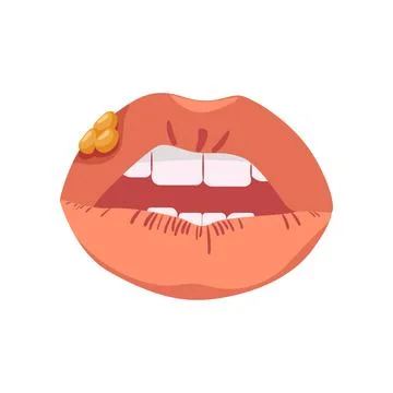 Lips with herpes. Infectious disease affecting mucous membranes Stock Illustration