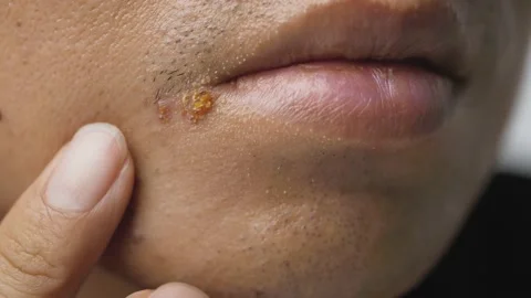 Lips herpes simplex virus symptoms. Stock Footage 157058096