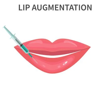 Lips injection Augmentation Illustrazione stock