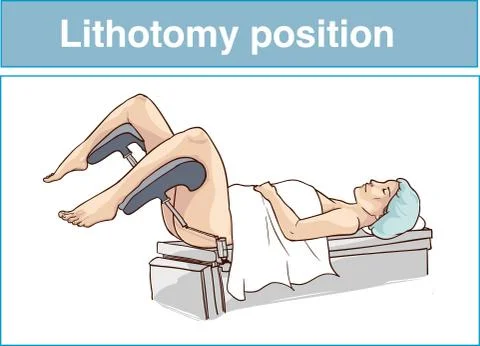 Lithotomy position vector illustration Stock Illustration