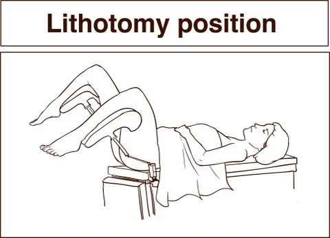 Lithotomy position vector illustration Stock Illustration