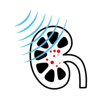 Lithotripsy procedure concept Stock Illustration