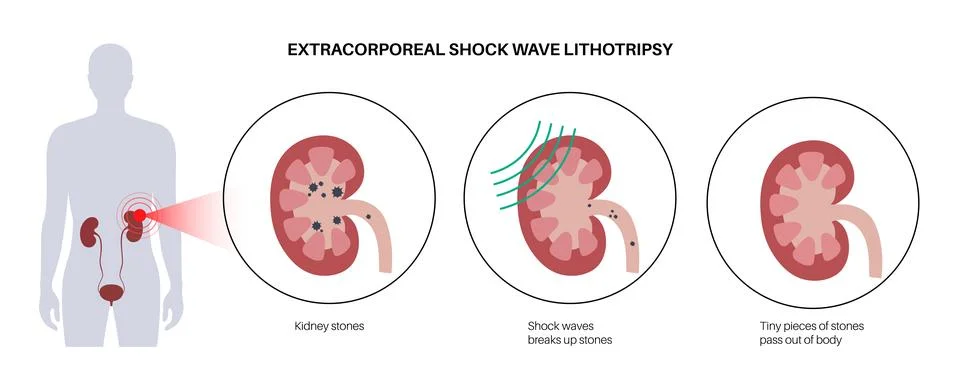Lithotripsy procedure concept Stock Illustration