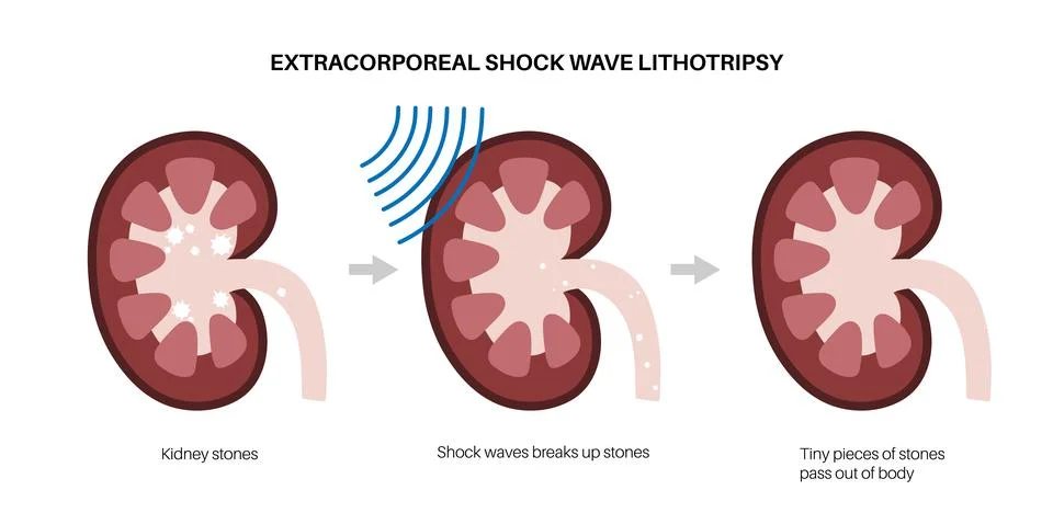 Lithotripsy procedure concept Stock Illustration