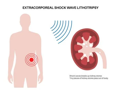 Lithotripsy procedure concept Stock Illustration