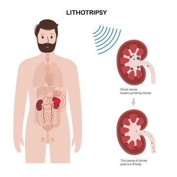 Lithotripsy procedure concept Stock Illustration