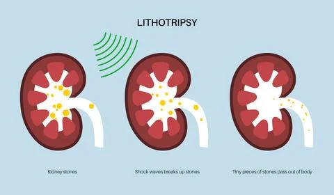 Lithotripsy procedure concept Stock Illustration