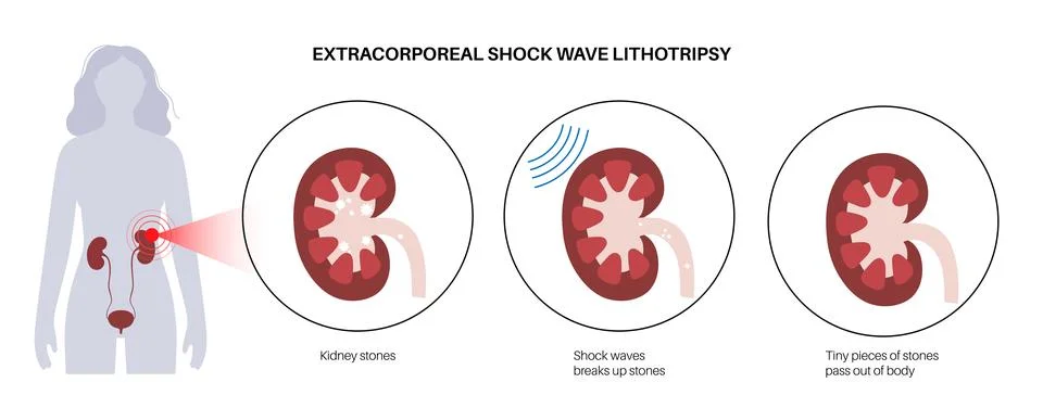 Lithotripsy procedure concept Stock Illustration