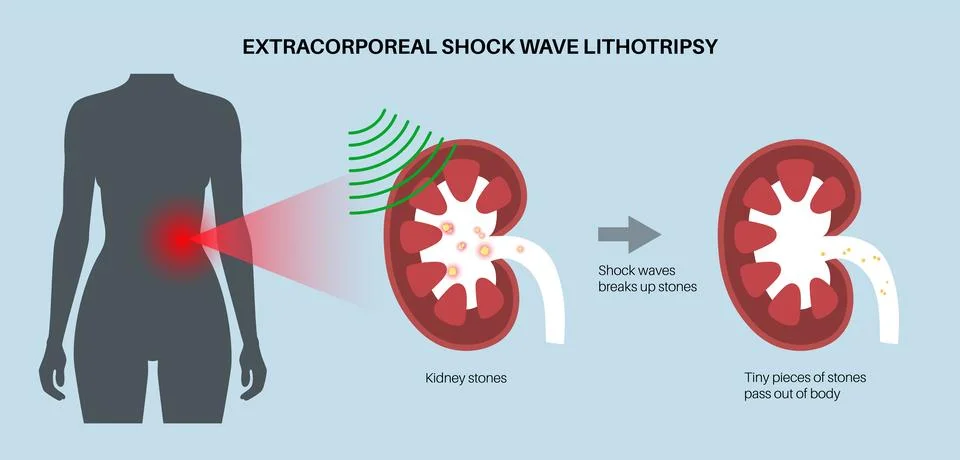 Lithotripsy procedure concept Stock Illustration
