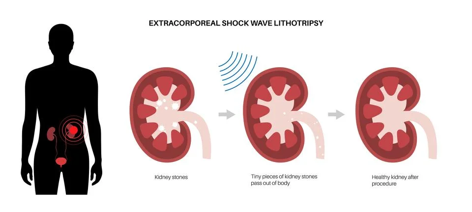 Lithotripsy procedure concept Stock Illustration