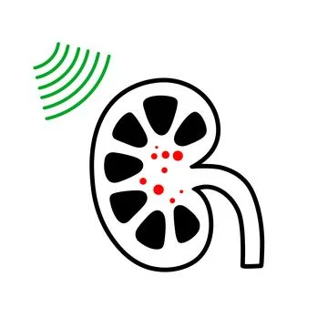 Lithotripsy procedure concept Stock Illustration