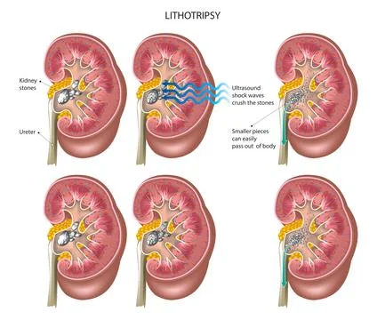 Lithotripsy Procedure Stock Illustration