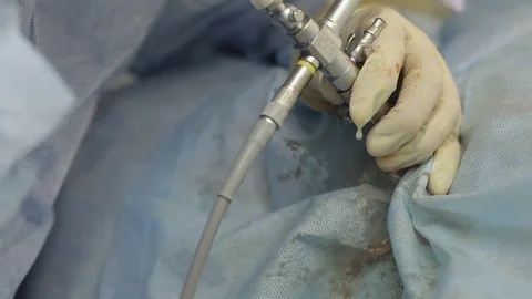 Lithotripsy surgery. hands of the surgeon at work 库存影片 80967790