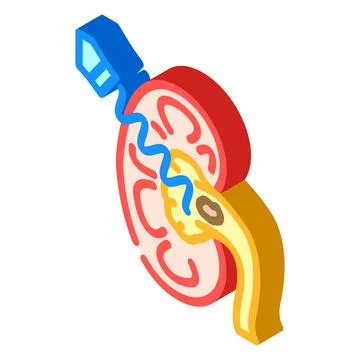 Lithotripsy urology isometric icon vector illustration イラスト素材