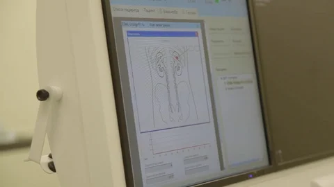 Lithotriptor screen in operating room Stock Footage 80155772