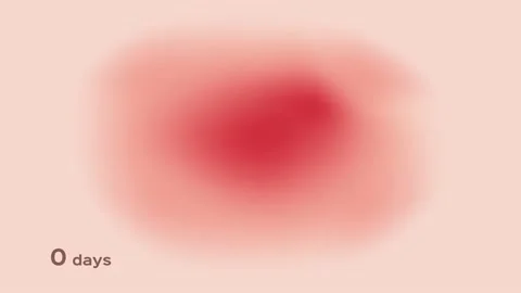 A little bit to serious bruised . It bleeding in side the skin graphic animation Stock Footage 133115930